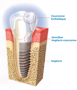 Implant dentaire